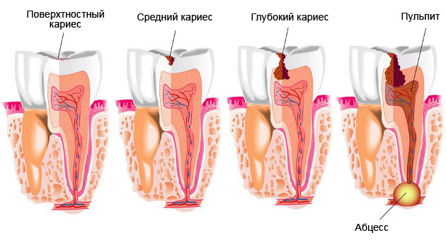 Механизм разрушения зуба
