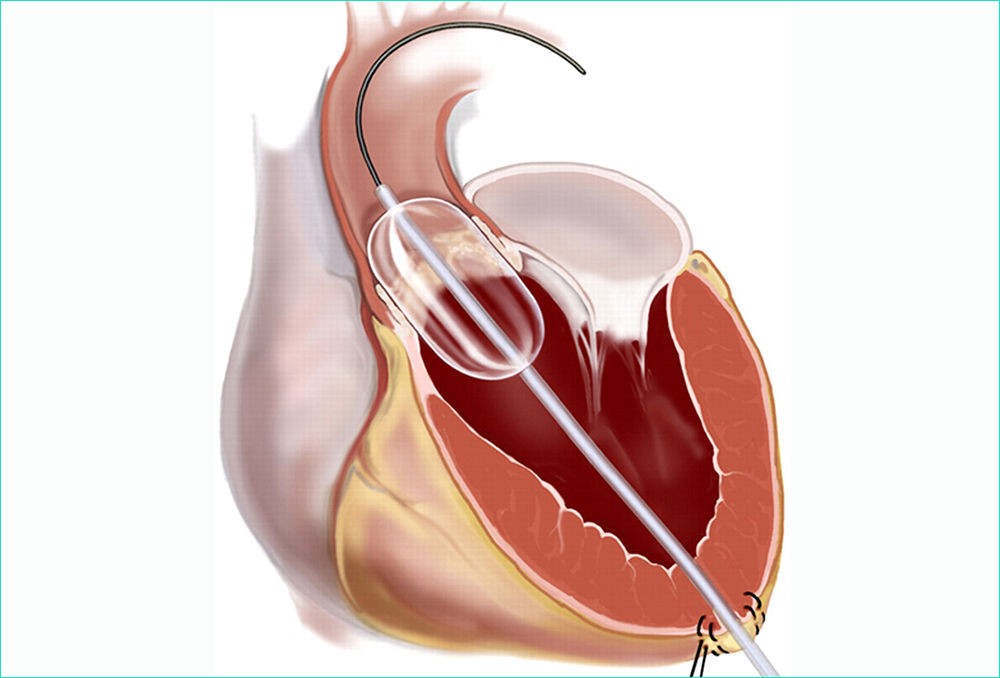 Баллонная вальвулопластика Баллонная вальвулопластика