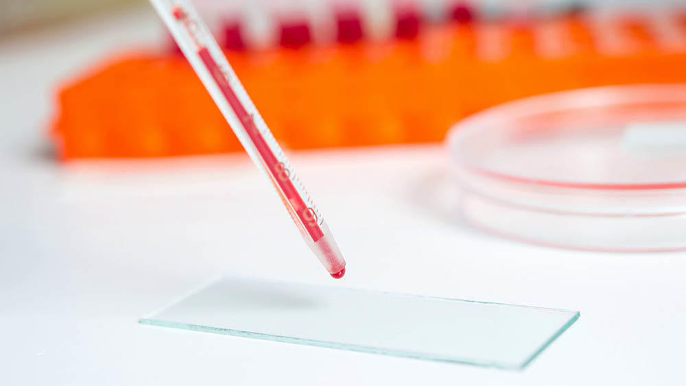 Что такое свёртываемость крови Что такое свёртываемость крови