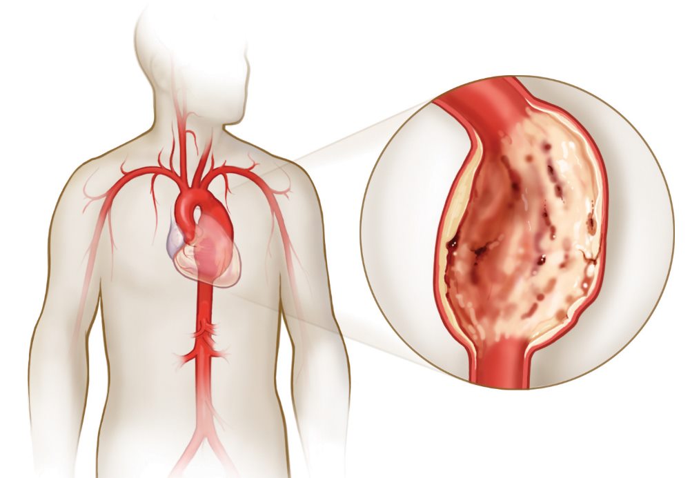 Аневризма брюшной аорты Аневризма брюшной аорты