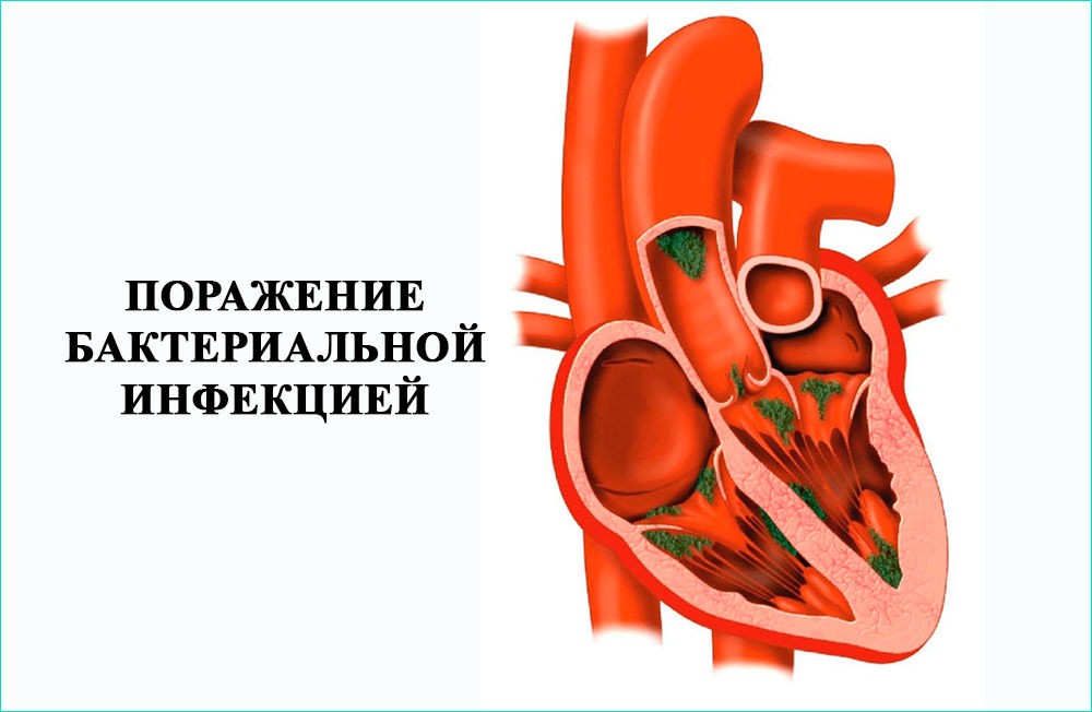 Поражение сердца бактериальной инфекцией Поражение сердца бактериальной инфекцией
