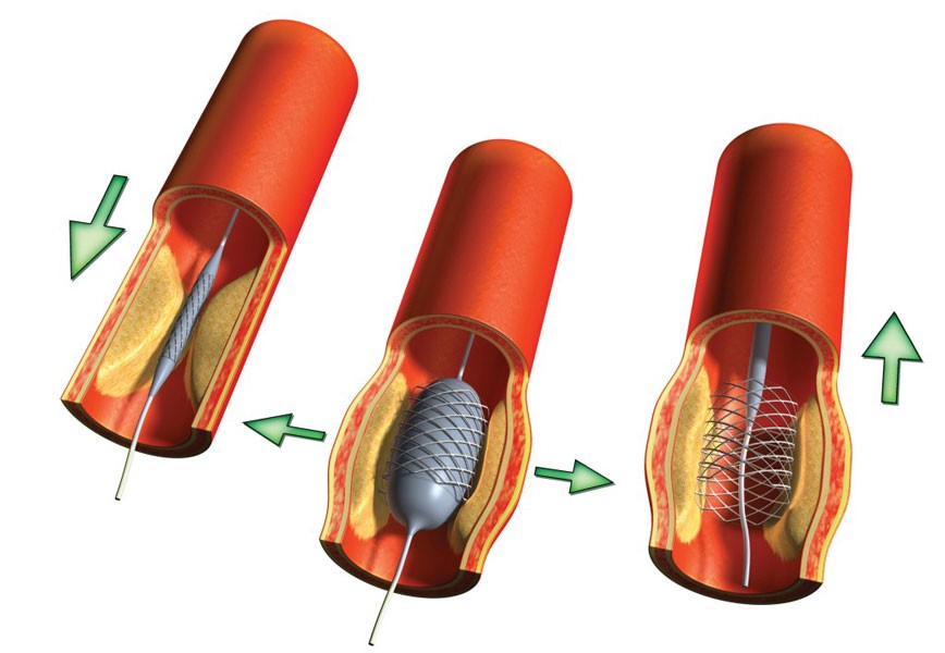 Баллонная ангиопластика и стентирование Баллонная ангиопластика и стентирование