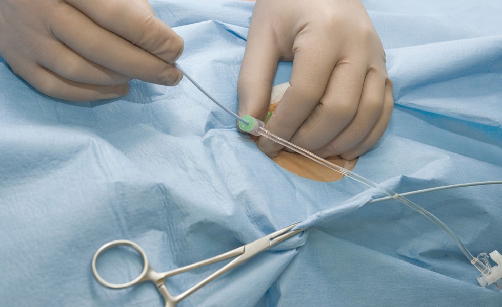 Чрескожная ангиопластика Чрескожная ангиопластика