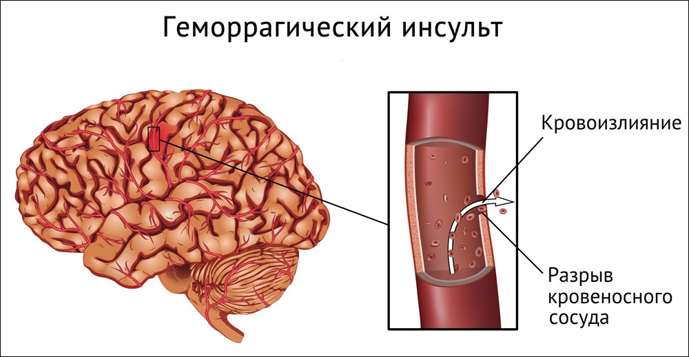 Геморрагический инсульт головного мозга Геморрагический инсульт головного мозга