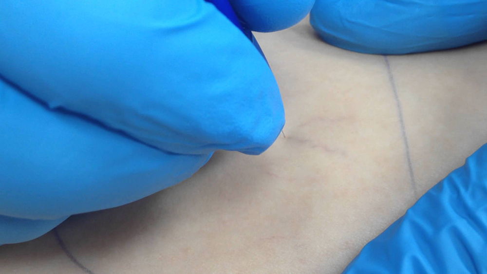 Термокоагуляция Термокоагуляция