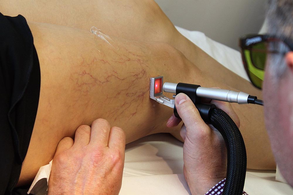 Лечение сосудов лазером Лечение сосудов лазером