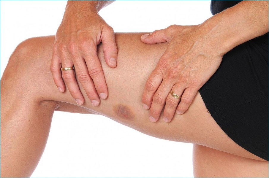 Лёгкое появление синяков Лёгкое появление синяков