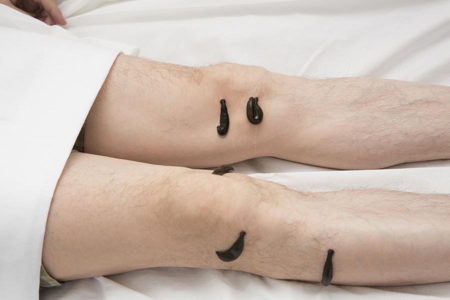 Метод лечения гирудотерапия Метод лечения гирудотерапия