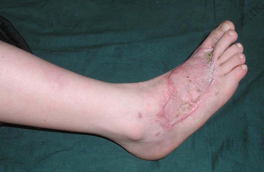 Некроз тканей ноги Некроз тканей ноги