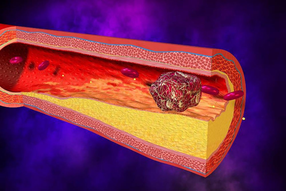 Образование тромба Образование тромба