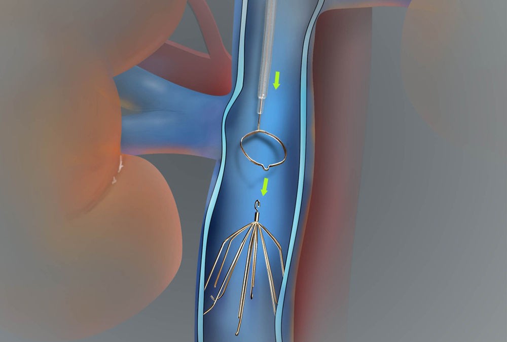 Использование кава-фильтра Использование кава-фильтра
