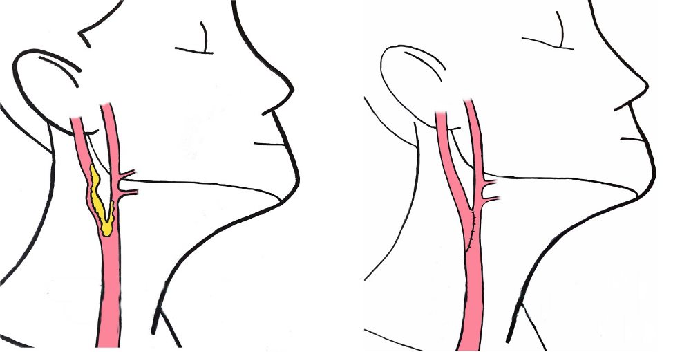 Оперативный способ по лечению стеноза сонных артерий оперативное вмешательство при стенозе сонных артерий
