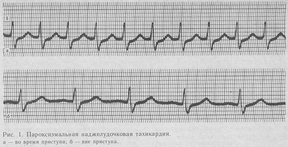 Пароксизмальная наджелудочковая тахикардия Пароксизмальная наджелудочковая тахикардия