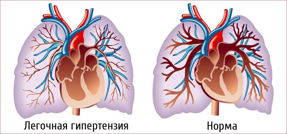 Принцип легочной гипертензии Принцип легочной гипертензии