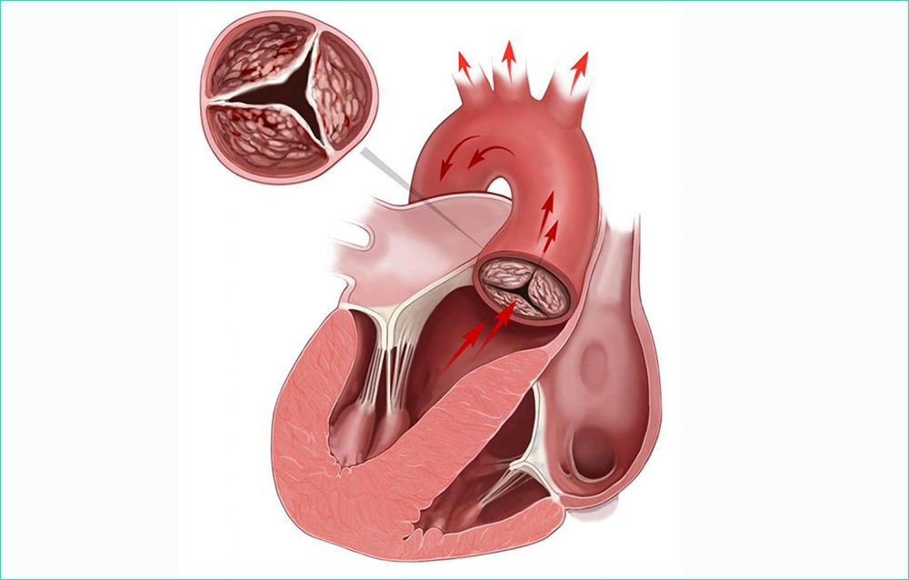 Механика развития стеноза Механика развития стеноза