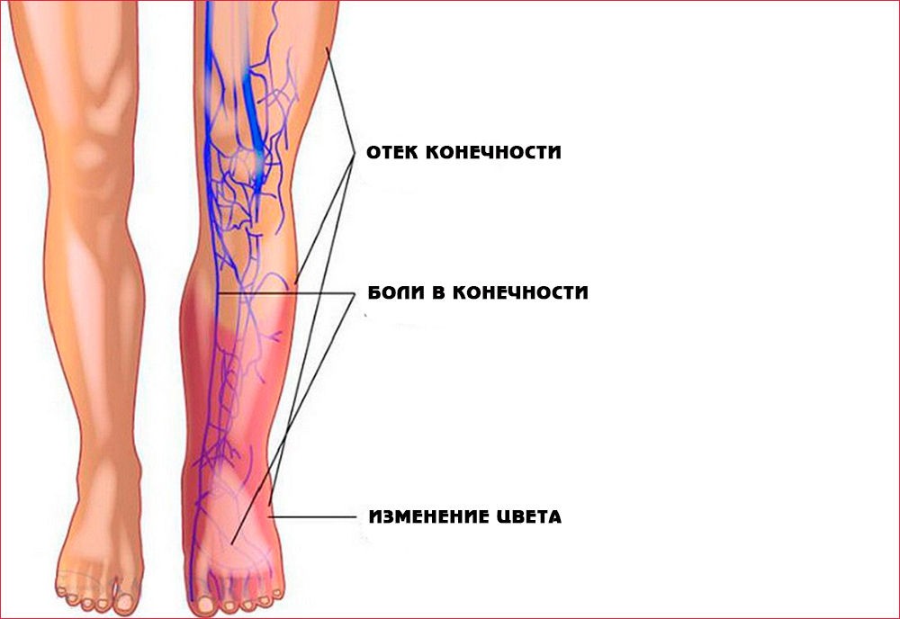 Признаки тромбоэмболии Признаки тромбоэмболии