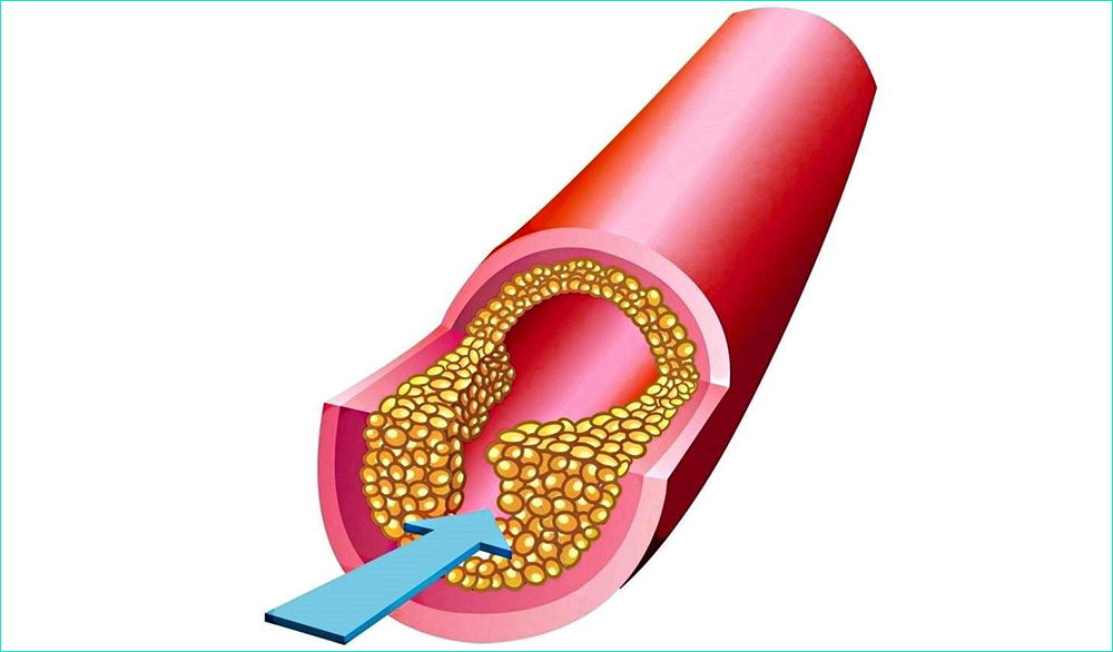 Процесс образования бляшки Процесс образования бляшки