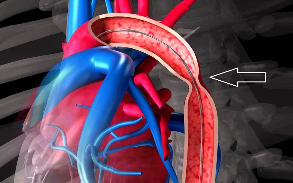 Проявление коарктации аорты Проявление коарктации аорты