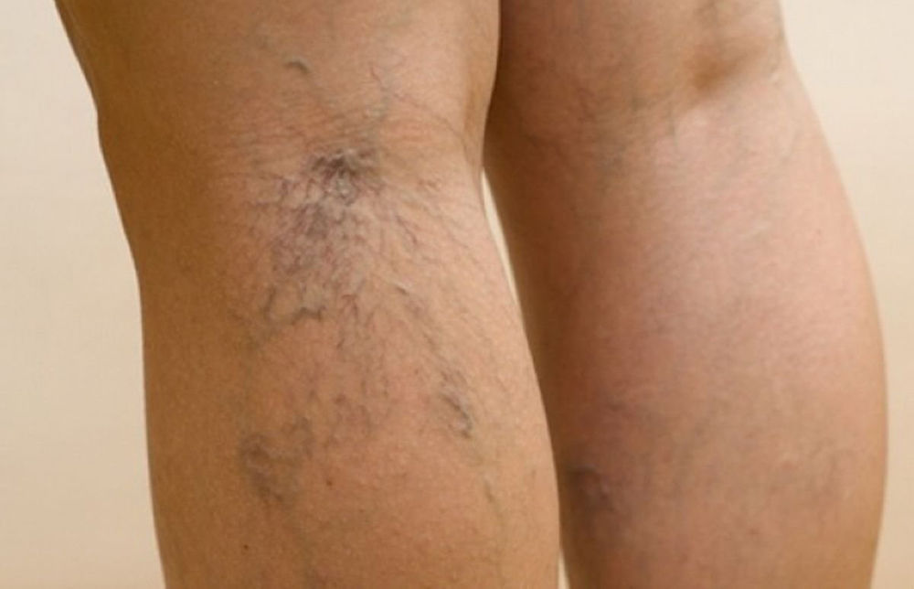 Проявления сосудистой сетки на ногах Проявления сосудистой сетки на ногах