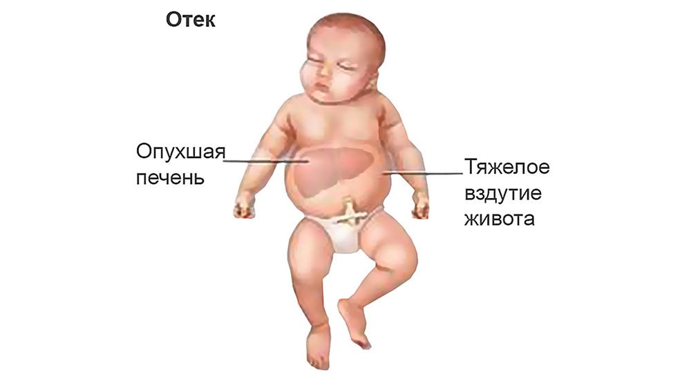 Симптомы резус-конфликта Симптомы резус-конфликта