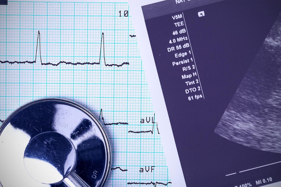 Синусовая тахикардия при беременности Синусовая тахикардия при беременности