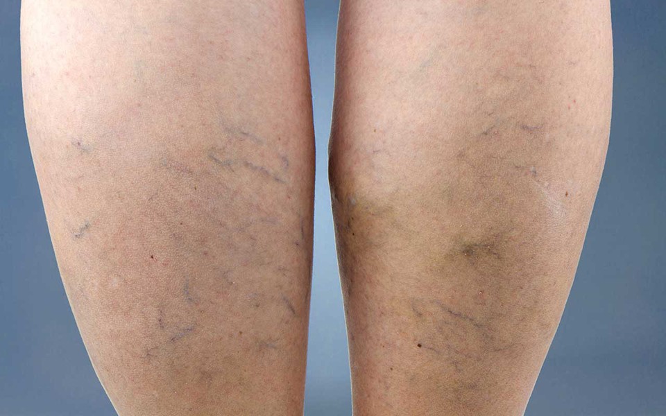 Слоновость нижних конечностей Слоновость нижних конечностей