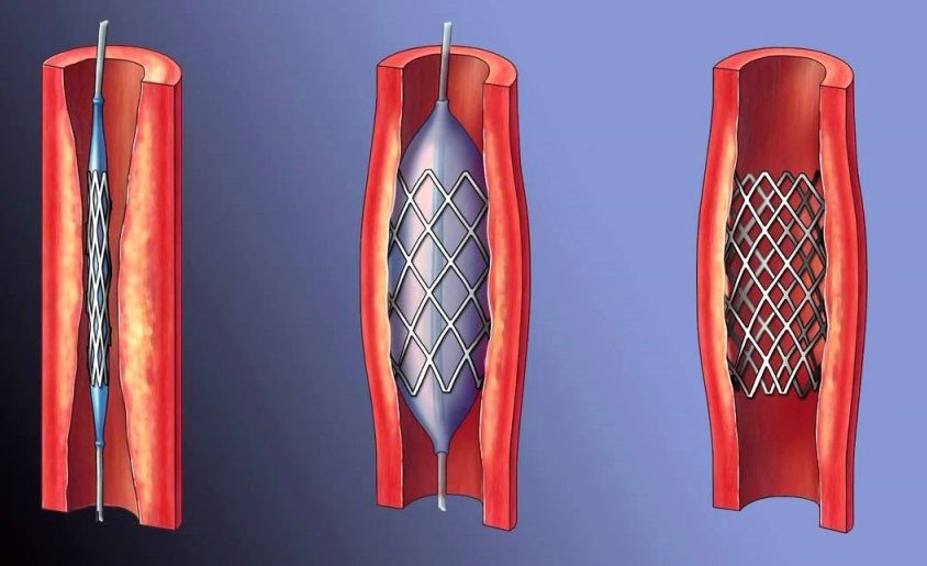Стент в артерии Стент в артерии