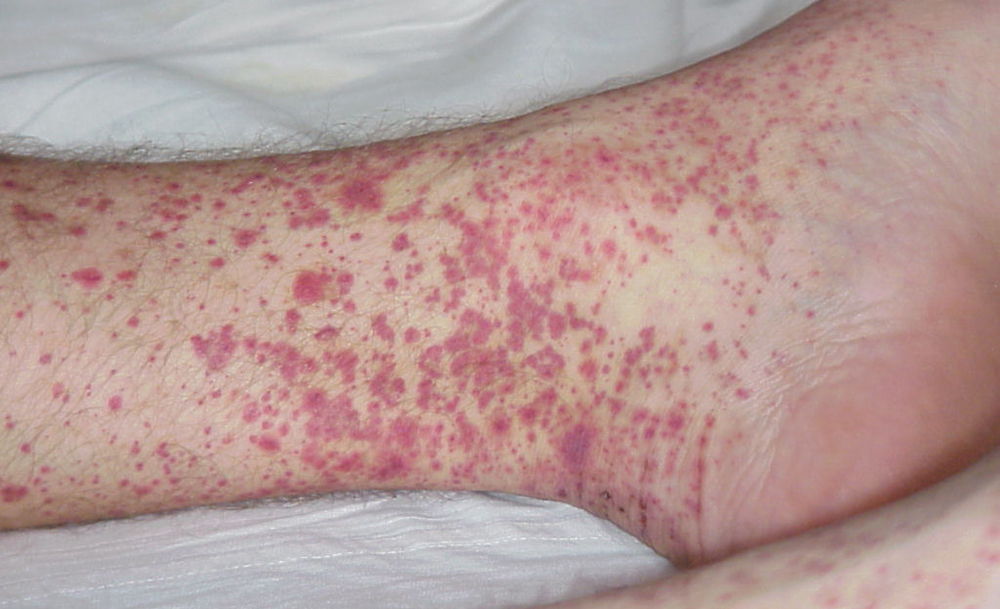 Сыпь при геморрагическом васкулите Сыпь при геморрагическом васкулите