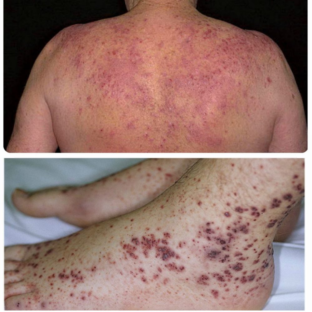 Подкожные кровоизлияния при тромбоцитопении точечные кровоизлияния на коже