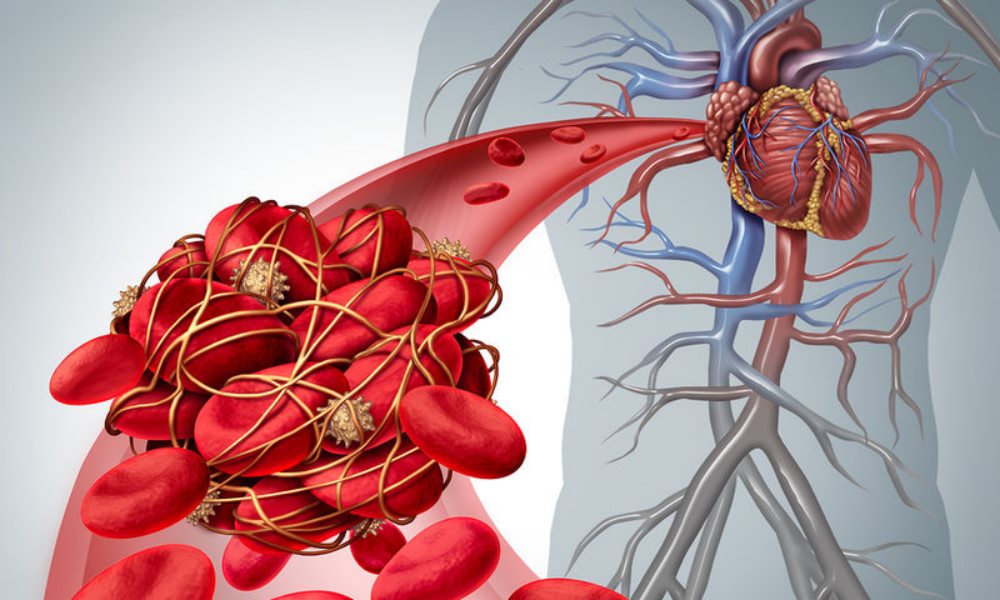 Свободное плавание тромба по кровеносному сосуду тромб может попасть легочную артерию