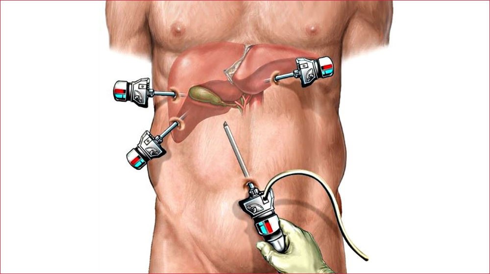 Удаление желчного пузыря Удаление желчного пузыря